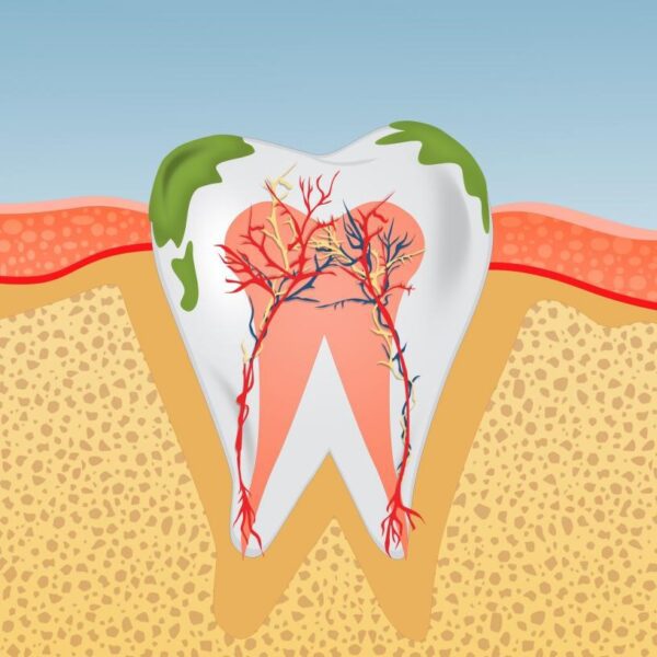 Top 4 Tips to Prevent Plaque BuildUp